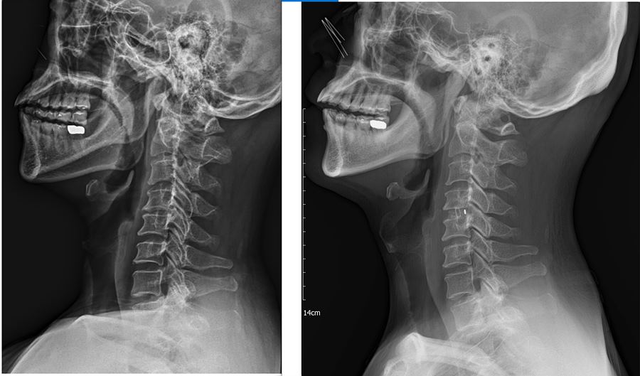 경추 X ray사진. 수술전(좌) 수술후(우)