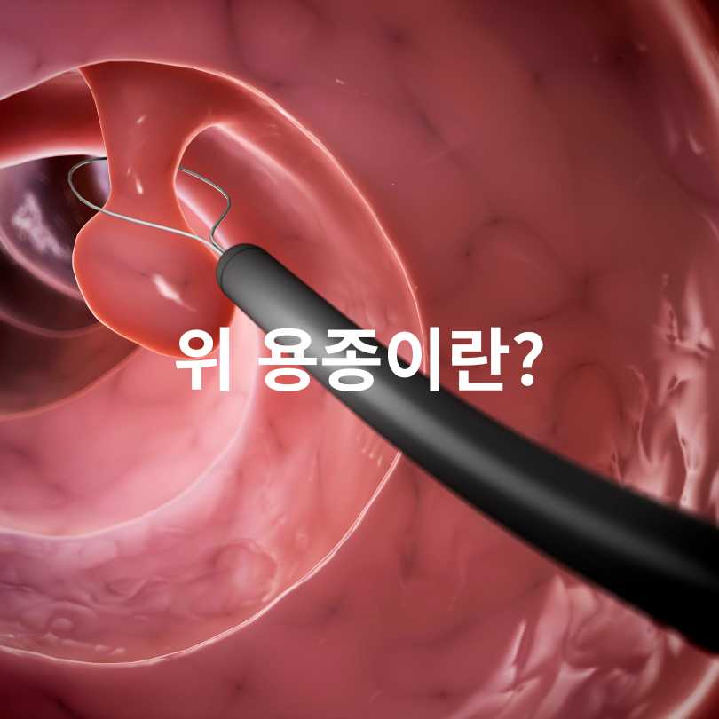 위 용종 암일확률? 걱정되는 분들을 위한 정확한 정보