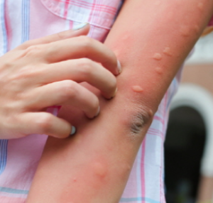 모기 물려서 가려울 때