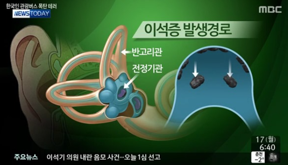 이석증 재발 막는 법