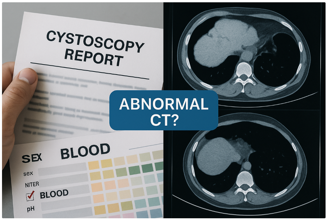 조영CT는 이상, 내시경은 정상, 미세혈뇨 원인은?