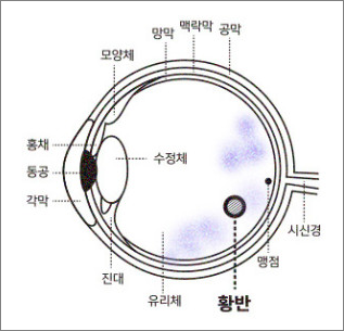 황반