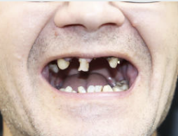 임플란트 종류가격차이점