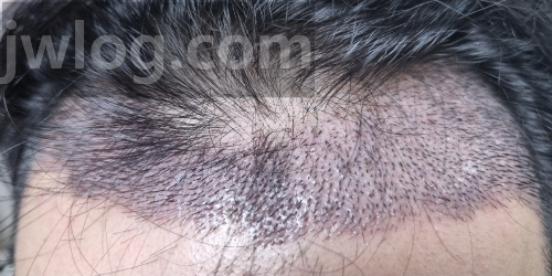 모발이식 10일차