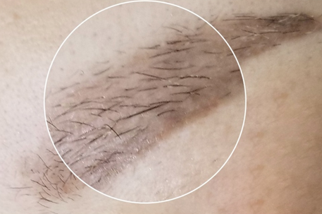 서울 눈썹문신 제거후 관리 제거비용 눈썹문신 제거 후기