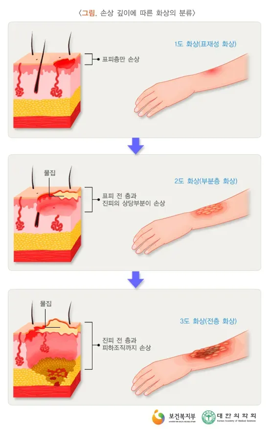 2도 화상 증상 자가치료 회복기간 응급처치법 정리_4
