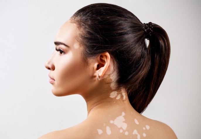 마이클잭슨이 앓았던 백반증 유전될까? 백반증 증상 원인 치료법