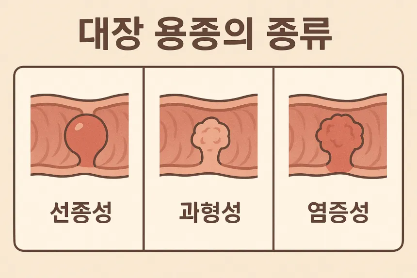 대장 용종 종류