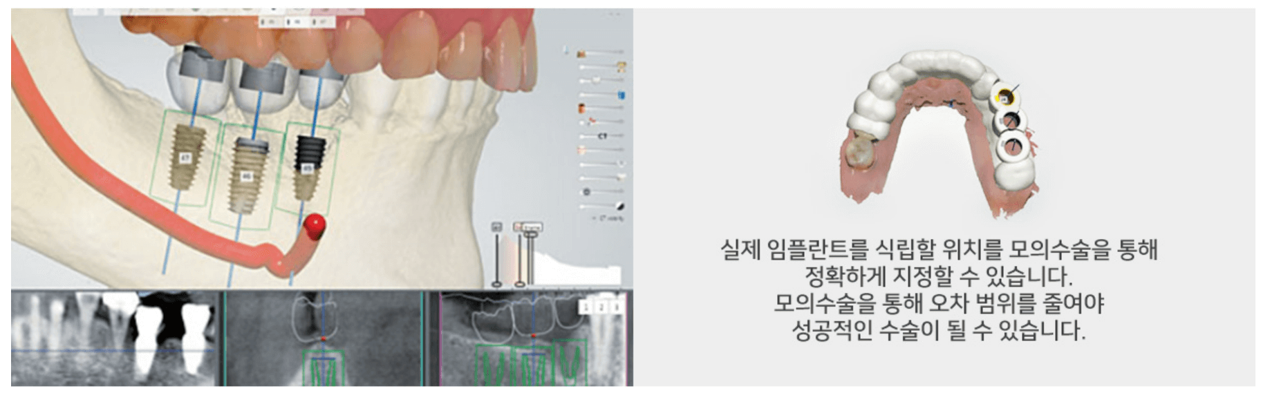 강남-크림치과-김정란원장-임플란트