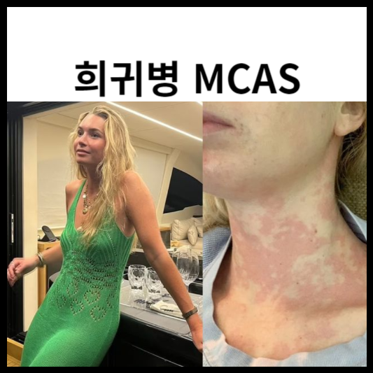 희귀병 MCAS