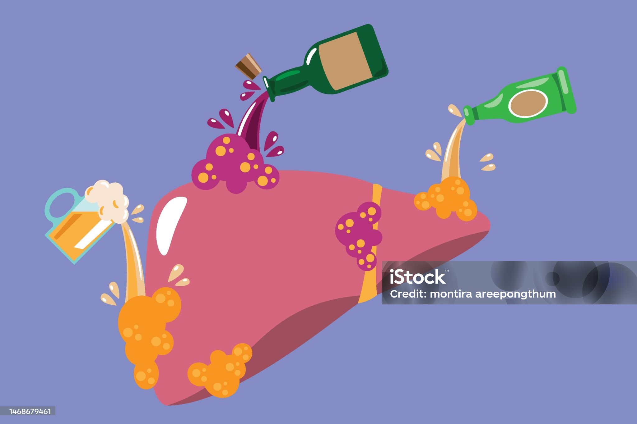 알콜성지방간-관련-사진