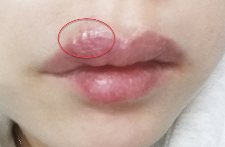 여성 헤르페스 1형 사진