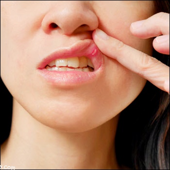 아프타성 구내염