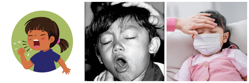 백일해 기침하는 어린이 사진 3개