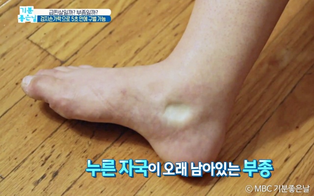 발목 종아리 붓기 부종 종아리가 붓는 이유, 건강 팁줌 매일꿀정보