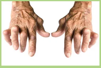 효과적인 류마티스 관절염 치료제 추천 약물 비교 가이드 2025 최신판_19