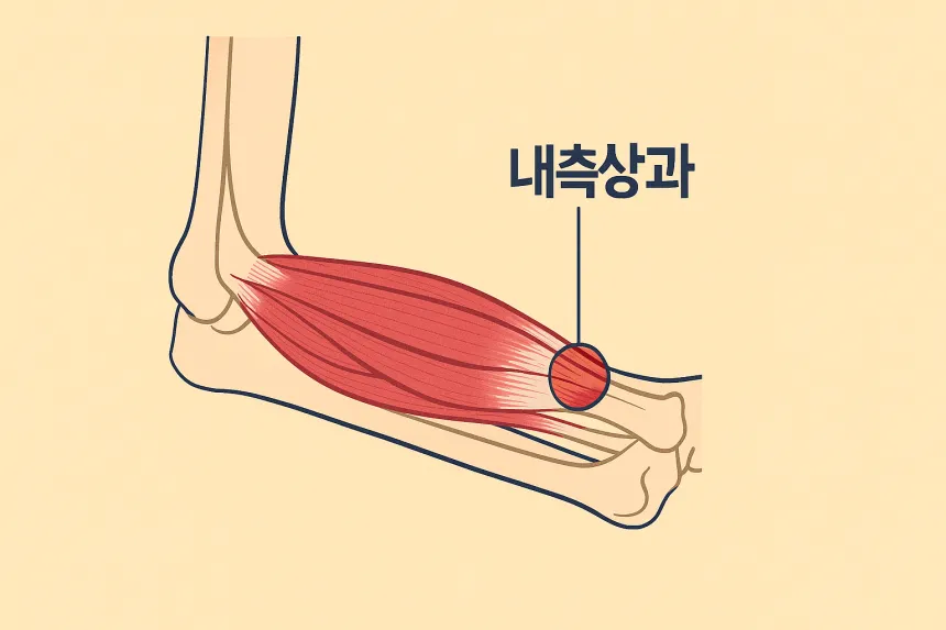 골프 엘보