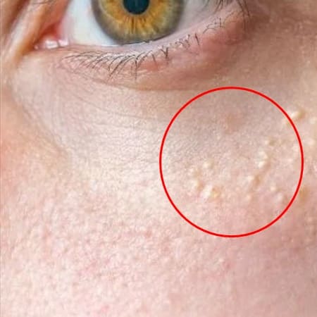 비립종 자연치유