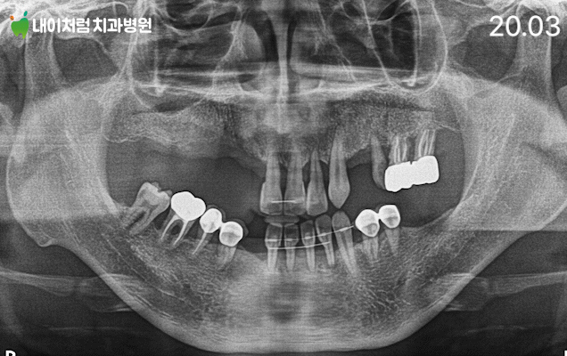 서울 이수역치과 전체 임플란트 전후