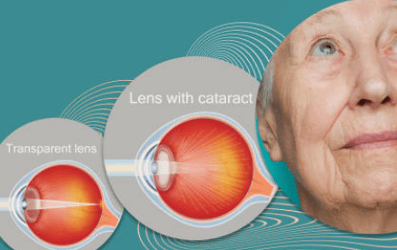 백내장 수술비용