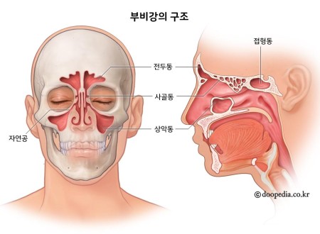 상악동염