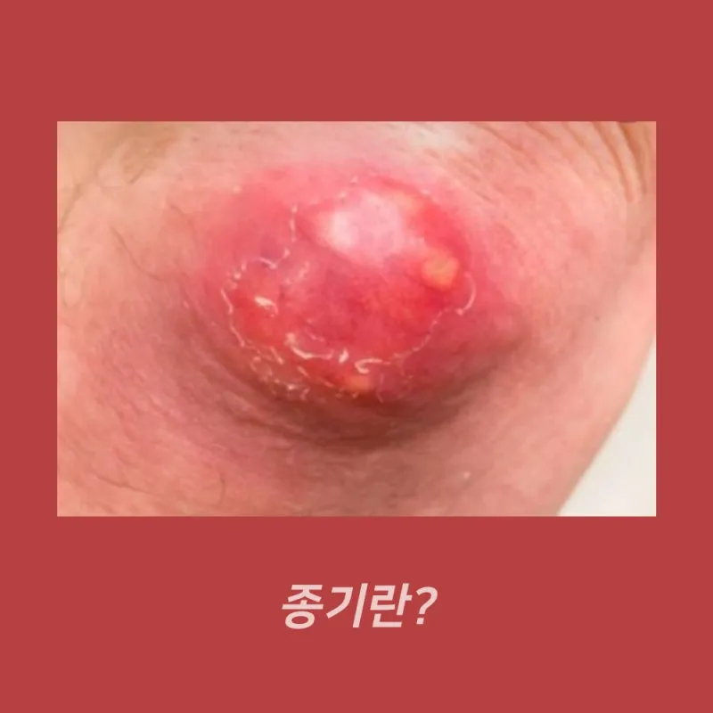 엉덩이 종기가 생기는 이유 왜 생기고 어떻게 관리할까요 완벽 가이드_4