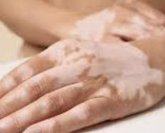 백반증 초기증상 12