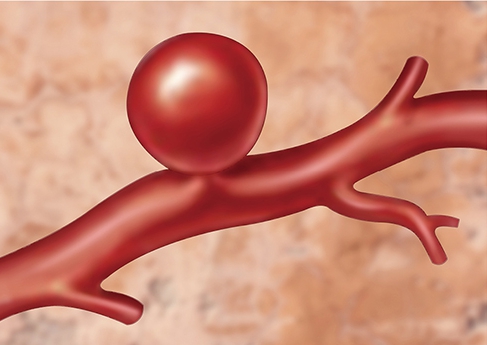 뇌동맥류 전조증상