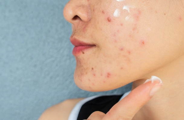 화농성 여드름 연고 3가지 추천 및 화농성 여드름 관리법 총정리 