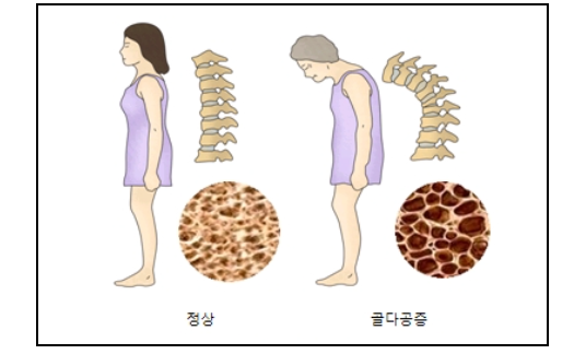 정상인과 골다공증의 골밀도