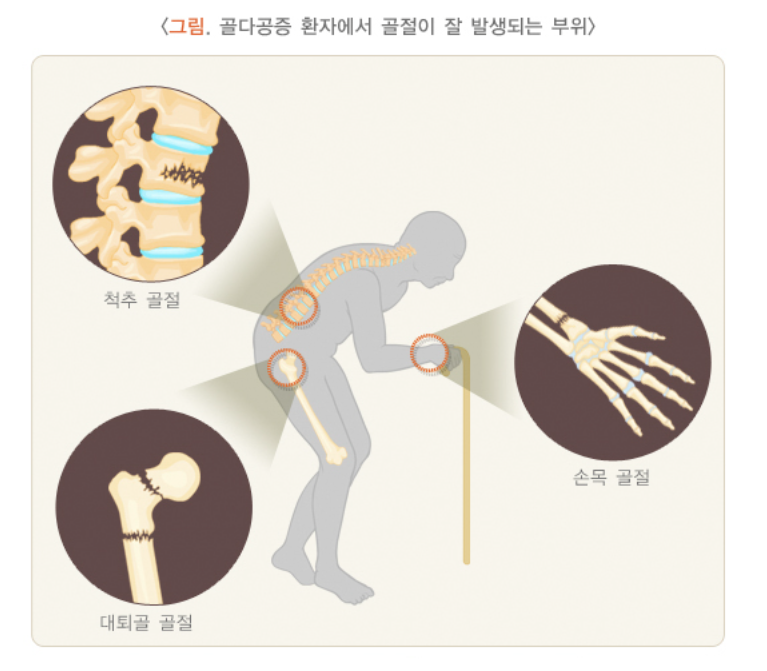 골다공증 환자에서 골절이 잘 발생되는 부위