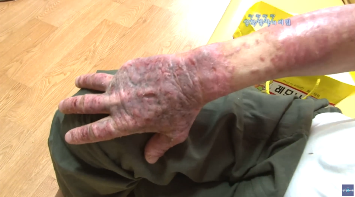 여름철피부건강 광알레르기 광민감성피부염 아토피 다한증 보상성다한증 액취증 콜린성두드러기 무좀