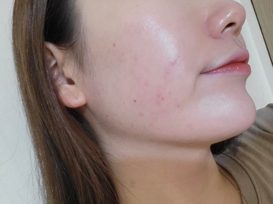 bbl 레이저 후기