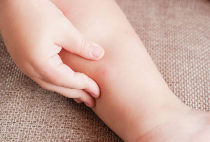 수족구 증상, 격리기간, 치료 총정리 (2024ver)