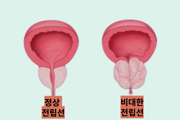 정상전립선과 비대한 전립선