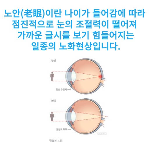 노안 치료