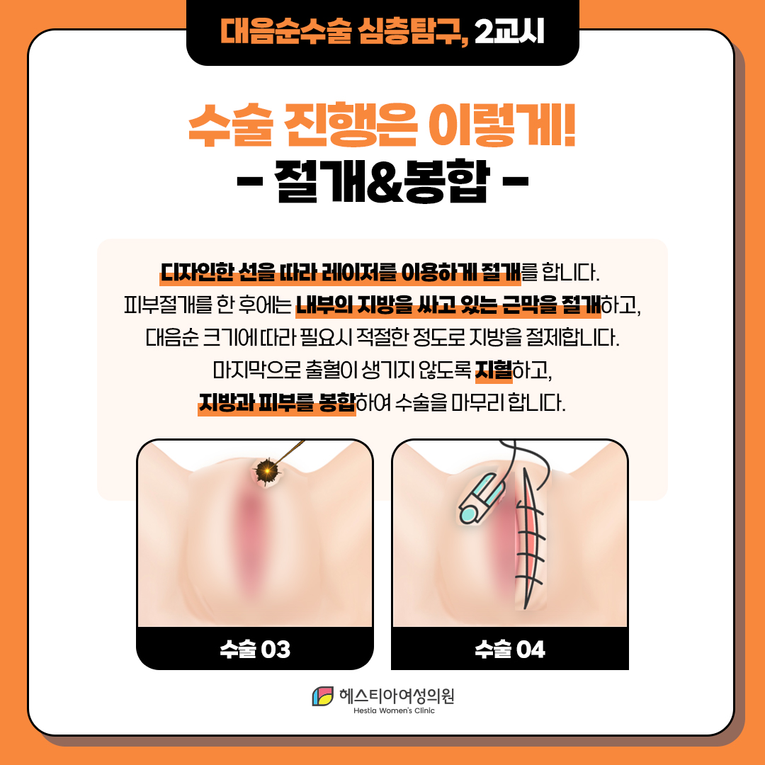 대음순수술 진행은 이렇게 진행돼요!