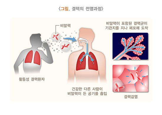 결핵환자와 폐렴