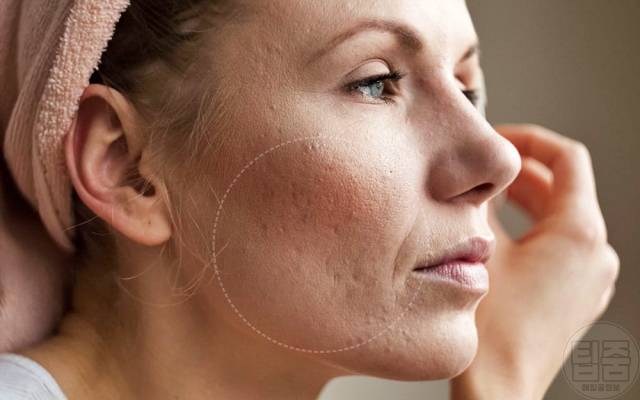 여드름흉터 치료 여드름흉터 없애는법 자연치유