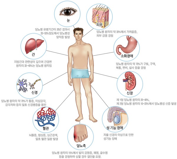 당뇨병 초기증상