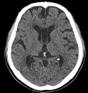 brain ct 축상면