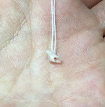 실에-미빨을-묶어-성공적으로-발치한-잔해물