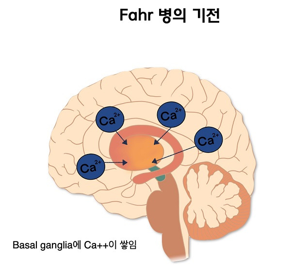 파르병(Fahr's Disease)