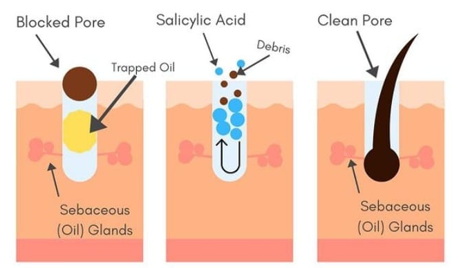 살리실산이-면포를-녹이는-원리
