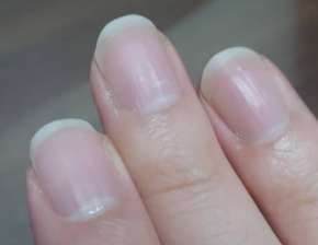 엄지손톱 가로줄