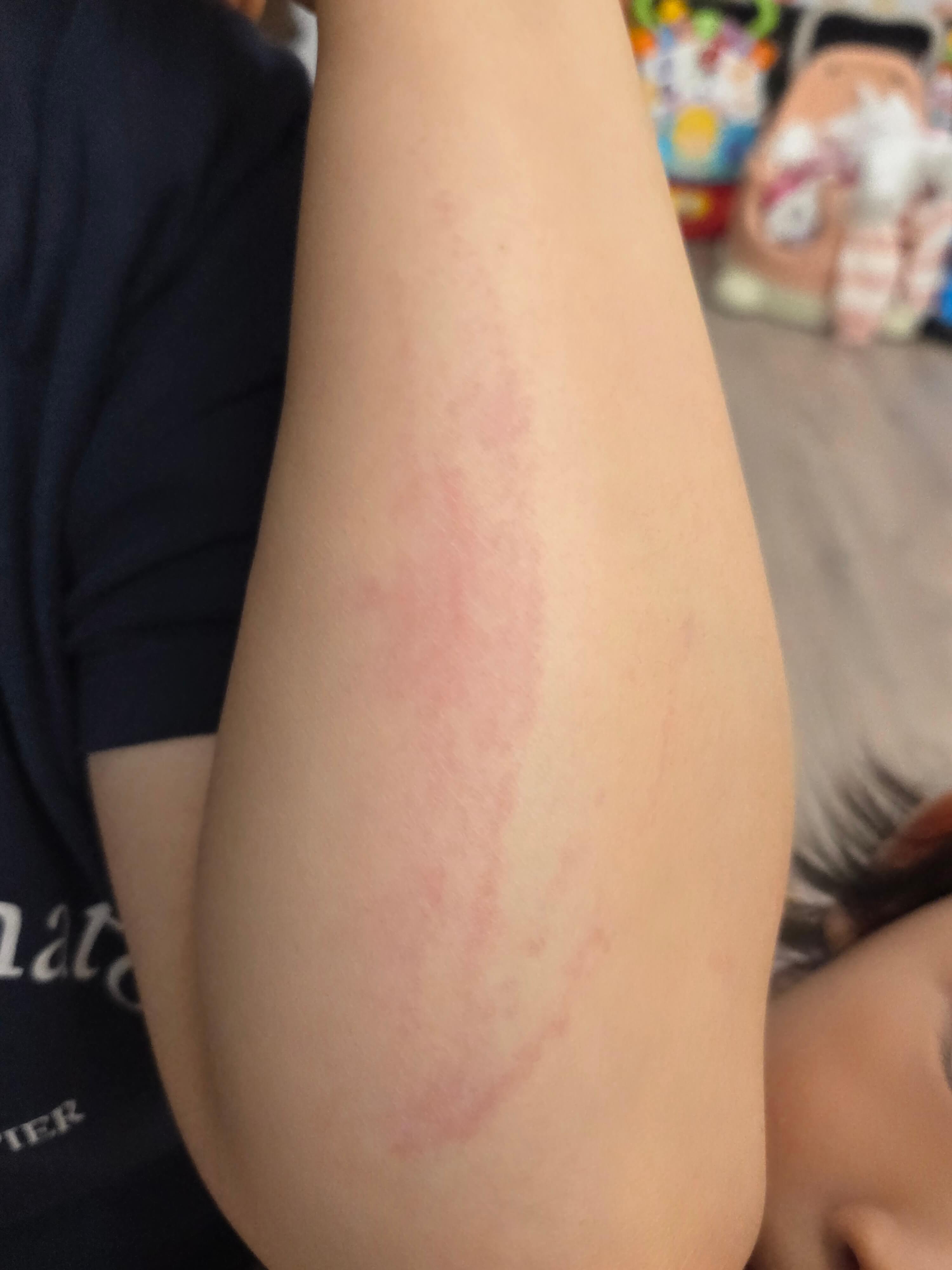 피부 발진과 가려움증 발생