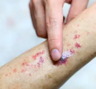 피부 붉은반점 5