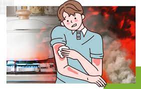 뜨거운 열기로 생긴 화상자국