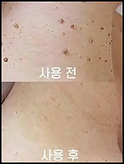 쥐젖 제거 방법