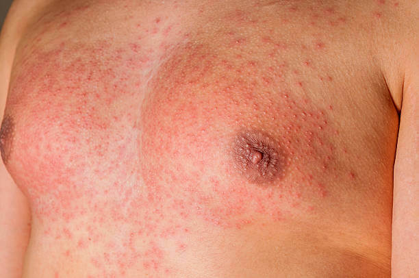 콜린성 두드러기 증상과 대처방법을 참고하세요. 